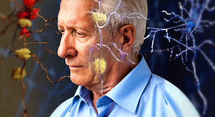 Alzheimer: la scoperta dell’origine del morbo